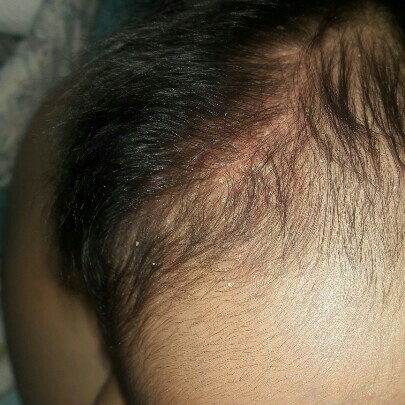 เป็นคล้ายๆรังแคค่ะ รักษาไงดีคะ