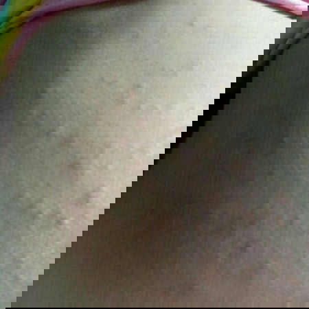ผื่นแดง