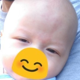 Merah pada Dahi Bayi