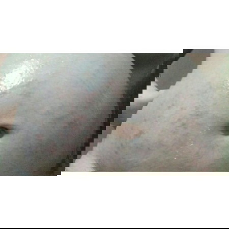 ALLERGY OR STRETCH MARKS?