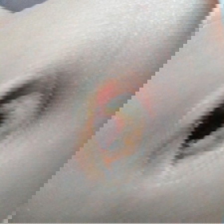 สะดือหลุดแล้วแต่เป็นแบบนี้ถือว่าผิดปกติไหมคะ