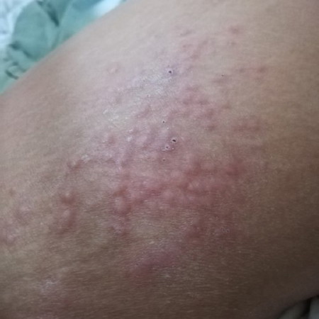 Skin Problem