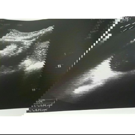 Cyst Ketika Hamil 10 minggu