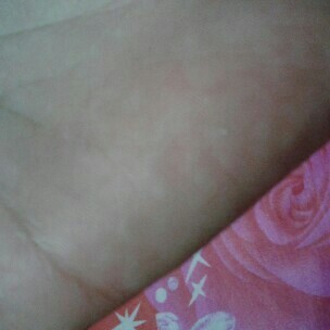 ตุ่มขึ้นใต้ผิวหนังเกาแล้วเป็นใสๆแดงคันมากควรไปหาหมอและอันตรายต่อลูกมั้ยคะ