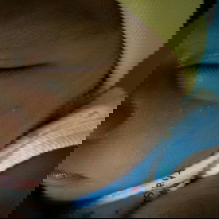 ตุ่มขึ้นหน้าน้อง