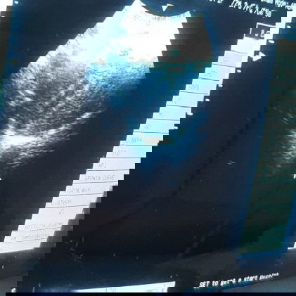 8w4d USG belum kelihatan janin