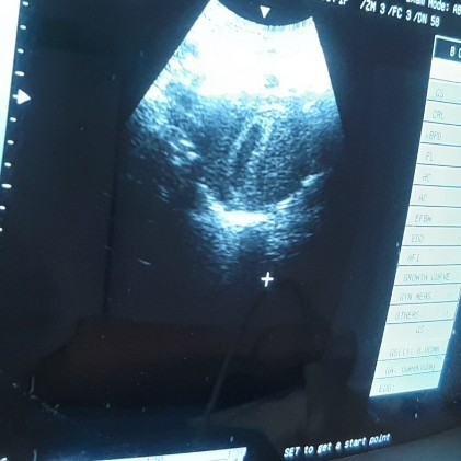 8w4d USG belum kelihatan janin