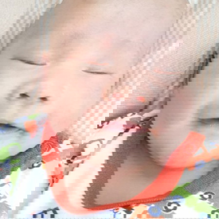 ผื่นที่หน้า