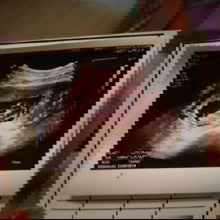 gambr Scan anak pertama kami