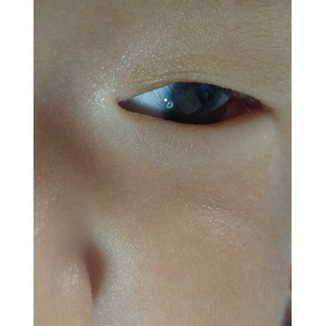 ในตาลูกมีจุดข่าวๆ