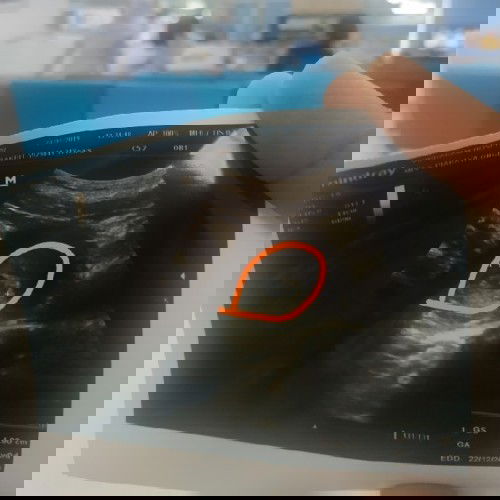 ได้เห็นการเต้นของหัวใจของลูกครั้งแรก