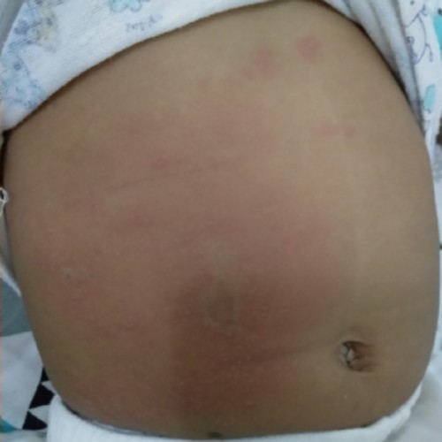 herpes dan cara ngobatinnya gmn