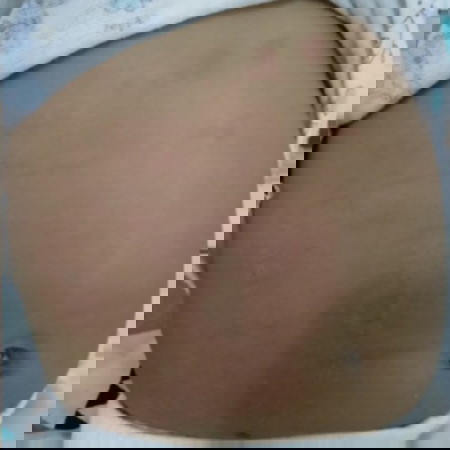 herpes dan cara ngobatinnya gmn