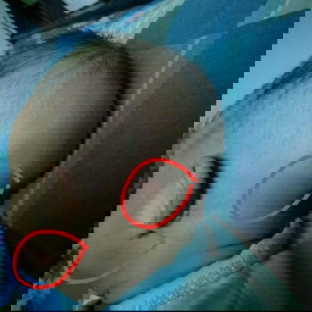 น้องมีตุ่มขึ้นเหมือนยุงกัด