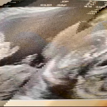 หมอนัดเจาะน้ำคร่ำ 17W