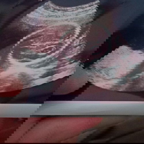 Cairan Di Otak Janin