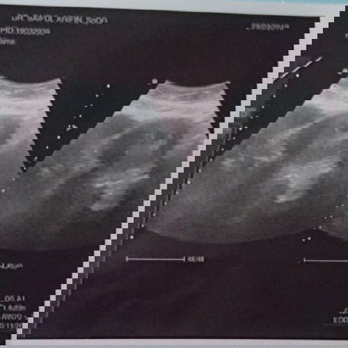 Setiap Usg Beda Beda Hitungan Kehamilan