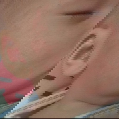 ผื่นแดง