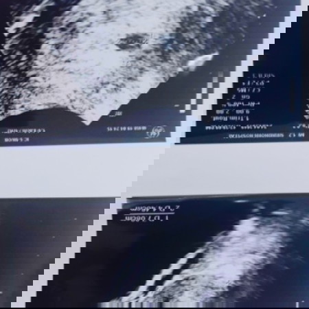 เลือดไหลออก2รอบ