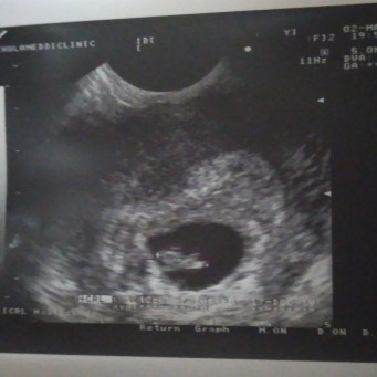 ภาวะแท้งคุกคาม