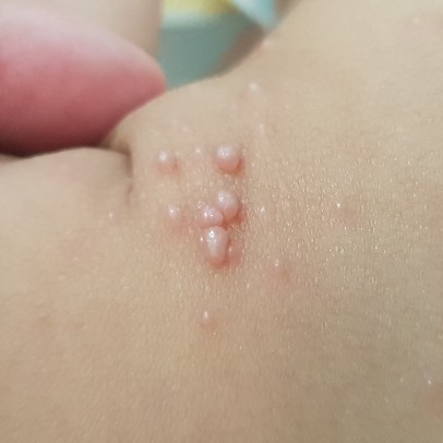 สวัสดีครับ ขอสอบถามเรื่อง ตุ่มที่ขึ้นในเด็กหน่อยครับ