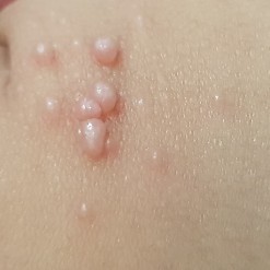 ตุ่มขึ้นตามตัวของลูก