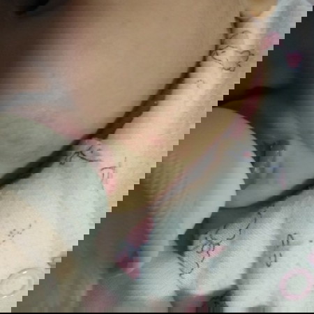 ผื่นแพ้