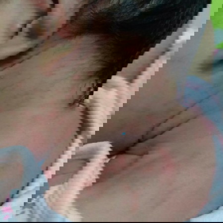 ผื่นขึ้น