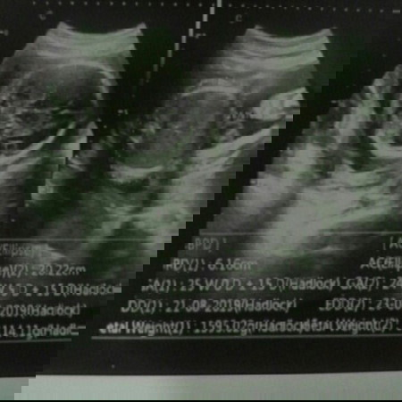 baca hasil usg janin 25 week