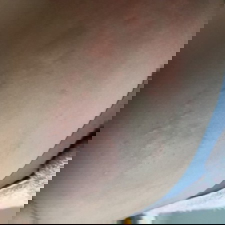 สวัสดีค่ะ ขอสอบถามคุณแม่ทุกๆคนที่เคยเป็นผื่นลมพิษหลังคลอดกันหน่อยค่ะ ว่าสามารถกินยาแก้แพ้อะไรบ้าง