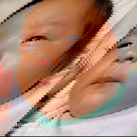 Spot In Face