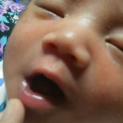 bercak putih