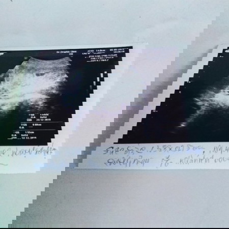 8w ซาวเห็นแต่ถุงตั้งครรภ์