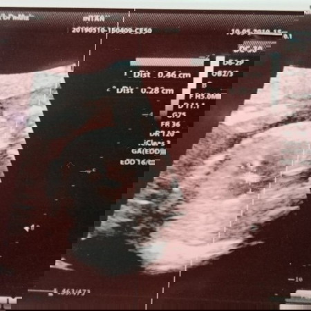 Jantung Anak Berlubang