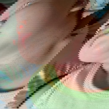 ผื่นแบบนี้รักษายังไงคะ