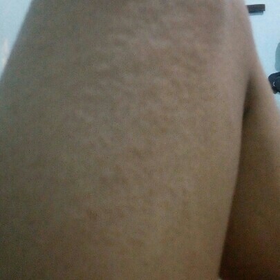 badan gatal