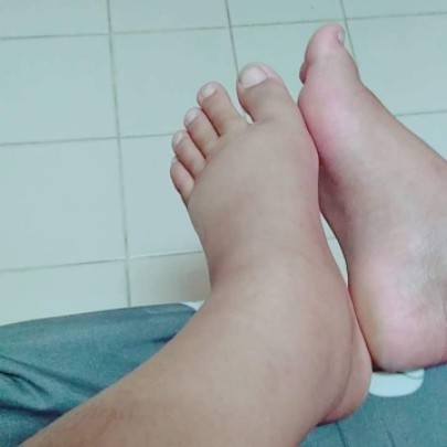 เท้าบวมมาก