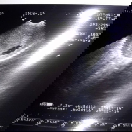 Usg 6w2d Bentuk Kantung Tidak Bulat