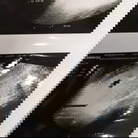 ภรรยาผมเป็นโรคหอบตอนนี้ 6w4day