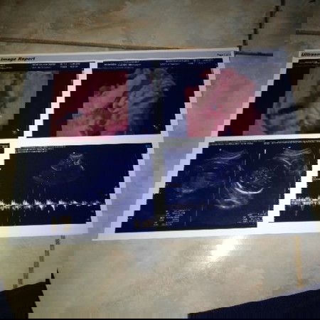 Hasil USG