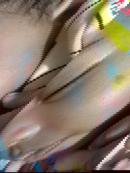 มีปานตั้งแต่แรกเกิด