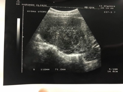 ตอนนี้ท้องได้ 5 สัปดาห์แล้วค่ะ แต่ไปซาวด์พบก้อนเนิ้องอก 10 เซน!!