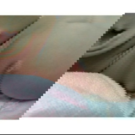 ปลูกฝีเป็นหนอง