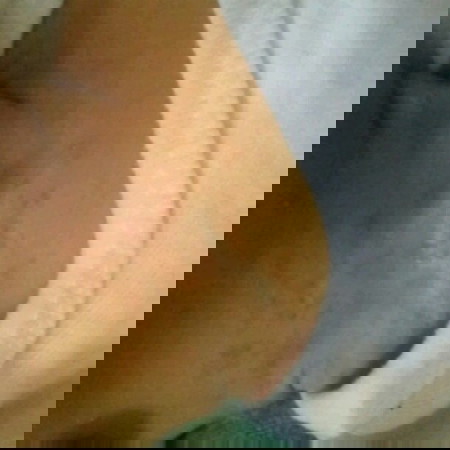 baby rashes..