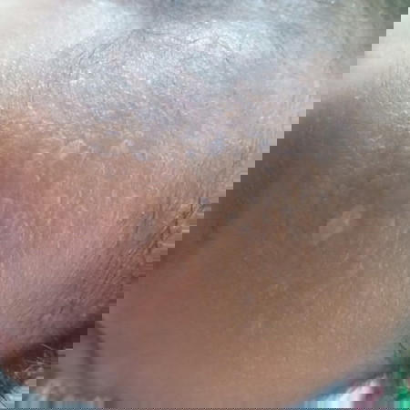 ลูก 13 วัน มีผื่นใส ๆ ขึ้นที่หน้าผากกับศีรษะ