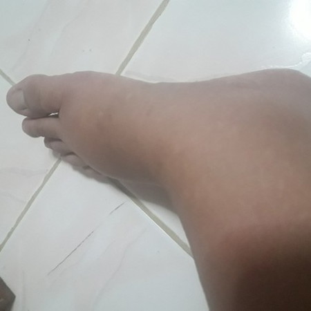 HELP Manas or Swelling