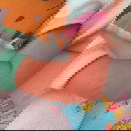 bintik merah pada bayi