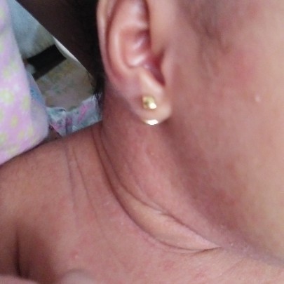 Baby Rashes