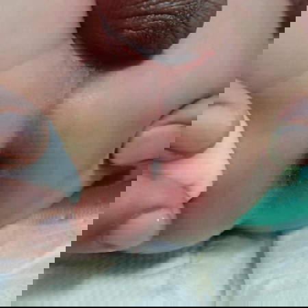 ฝี