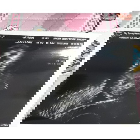 cara baca usia kehamilan dalam hasil usg